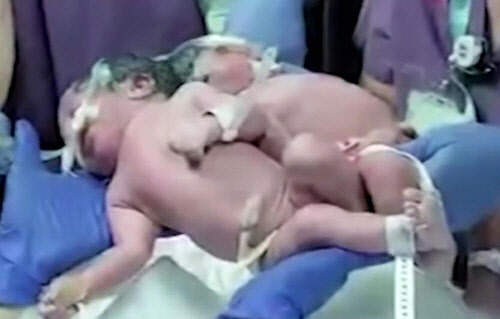 머리 붙어 태어난 샴쌍둥이 수술 직전 샴쌍둥이 모습.    [로이터]